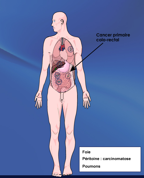Sites des principales métastases du cancer colorectal | Palli ...