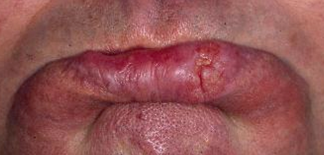 Cancer épidermoïde de la lèvre